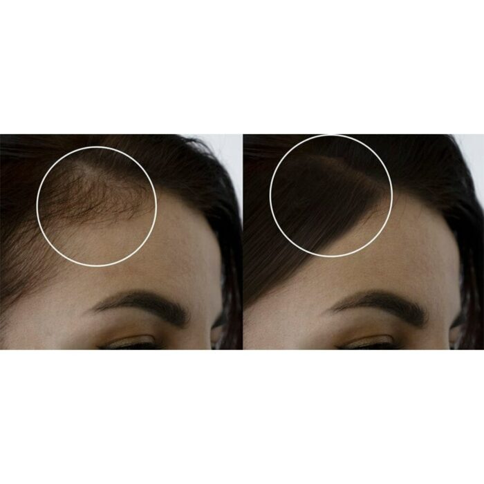 Hairtion Xlh Spray Get Many Hair Anti Baldness And Hair Loss Treatment For Hair Growth For 2