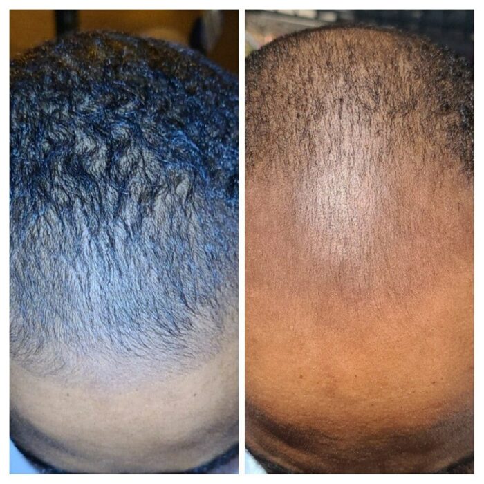 Hairtion Xlh Spray Get Many Hair Anti Baldness And Hair Loss Treatment For Hair Growth For 5