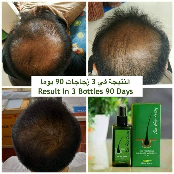 Neo Hair Lotion 120ml Hair Grow Serum Hair Growth Treatment Spray Thailand Original Products Essence Hair 2